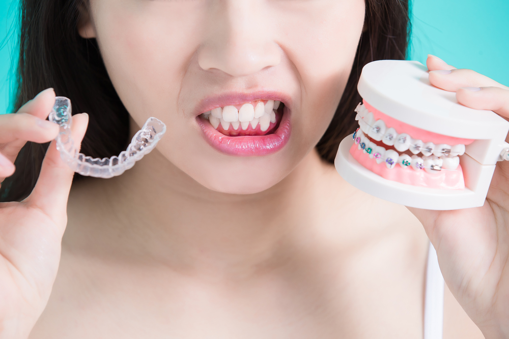 Invisalign vs Traditional Braces