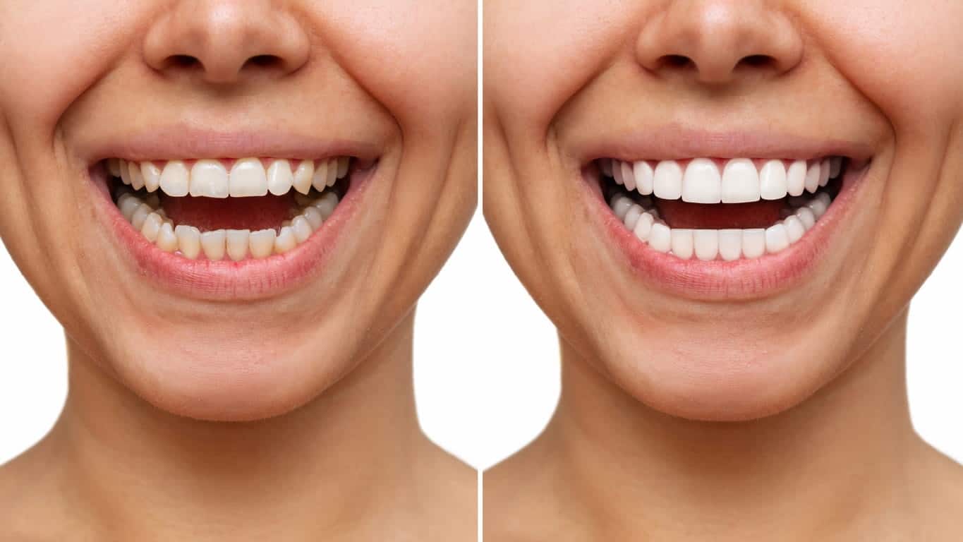 Bergenfield teeth whitening before and after photos.