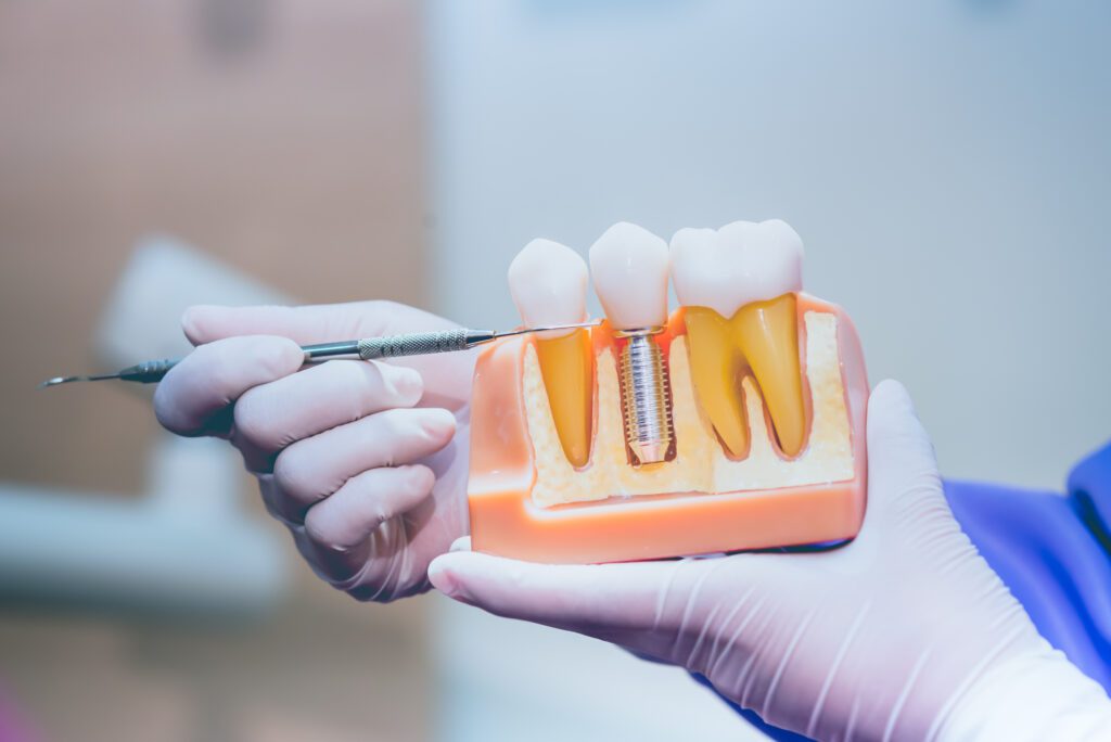 Dental Implants at Bergenfield NJ Dentist Office - Restorative dentistry services in Bergenfield, New Jersey.