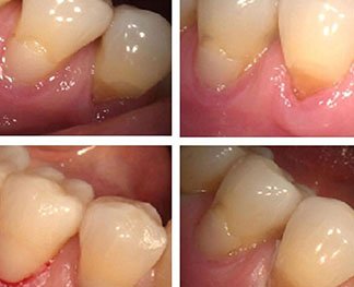 Dental Fillings Tenafly NJ